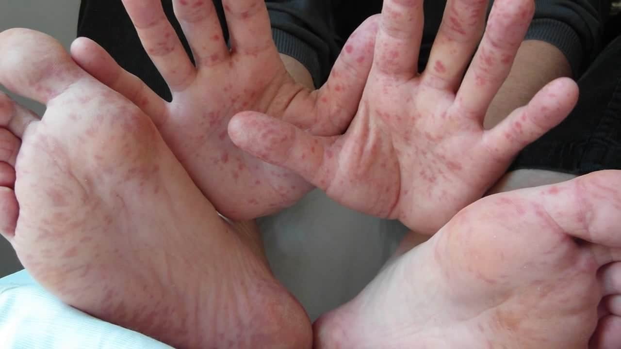 Confirman en Morelos cuatro alumnos contagiados de Coxsackie ¿Cuáles son los síntomas de este virus?