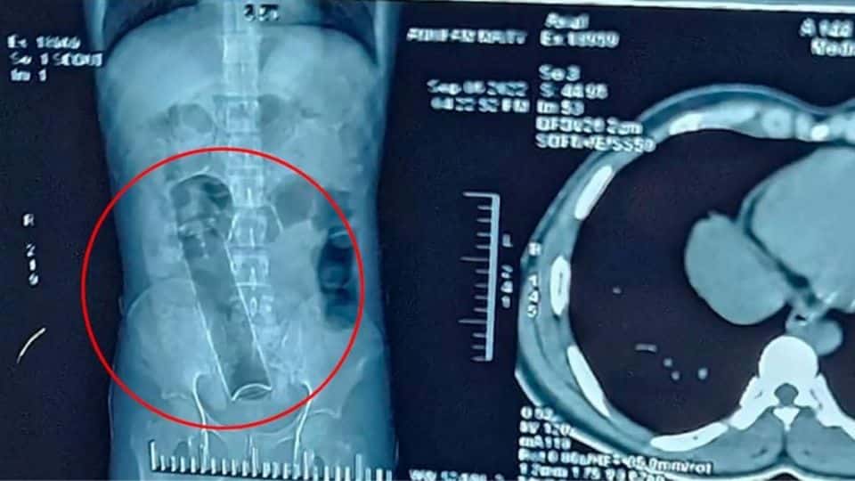 ¡Insólito! Acudió al hospital por dolor abdominal y le encontraron un desodorante en el colon