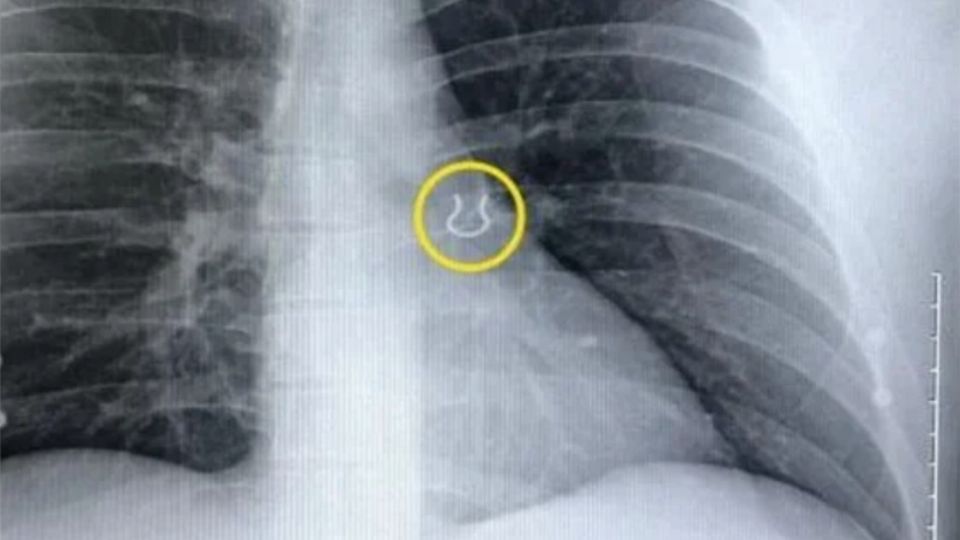 ¡No era neumonía! Hombre descubre piercing atorado en sus pulmones; lo había perdido hace 5 años