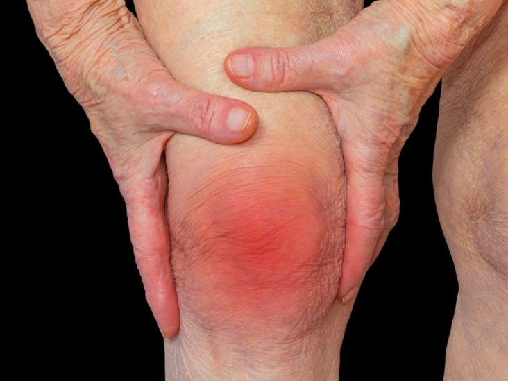 ¡Di adiós a las reumas! Remedios caseros para la artritis reumatoide