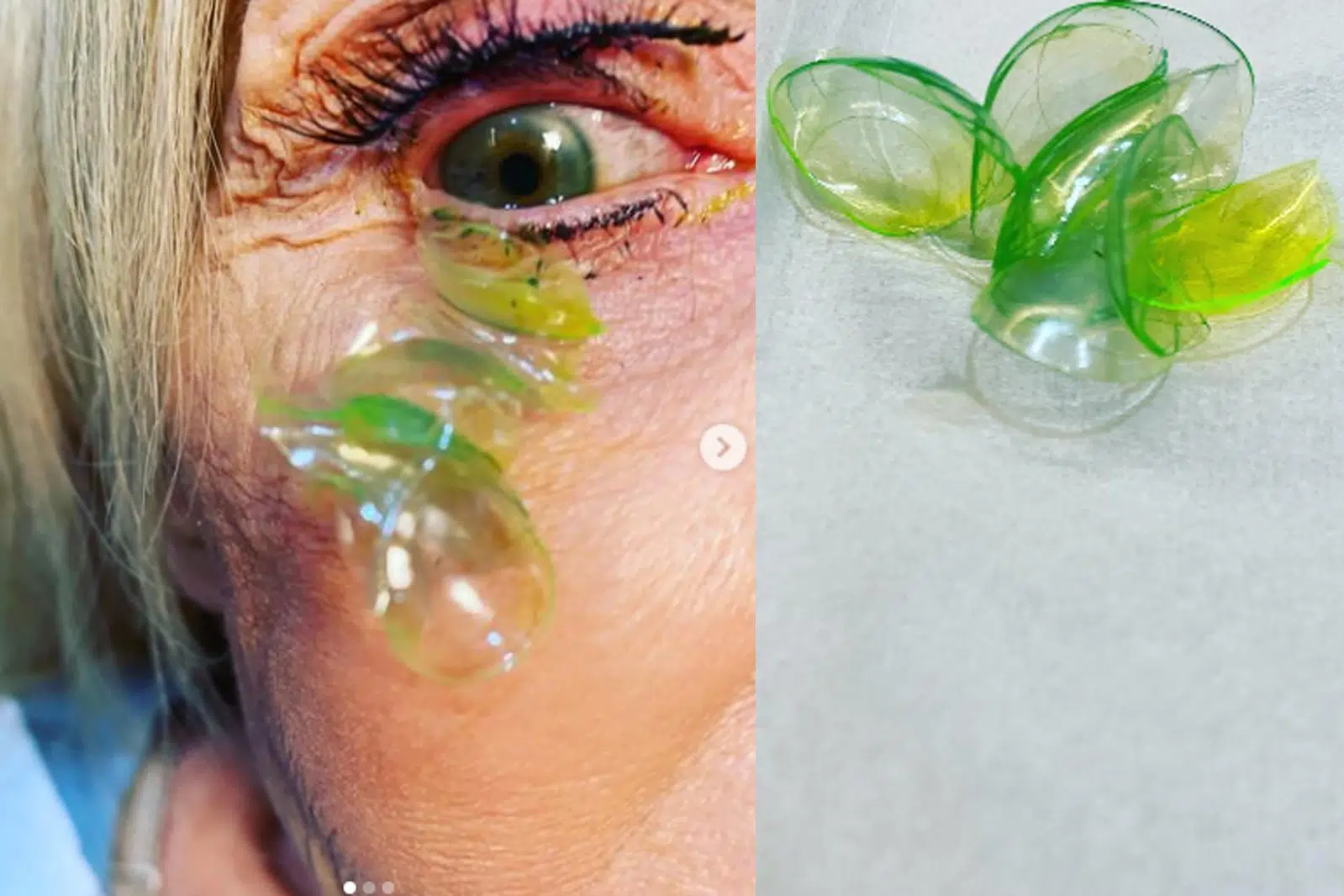 Así fue como removieron 23 lentes de contacto del ojo de una mujer