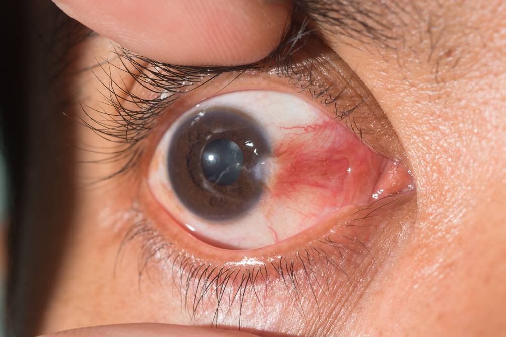 Carnosidad ojo