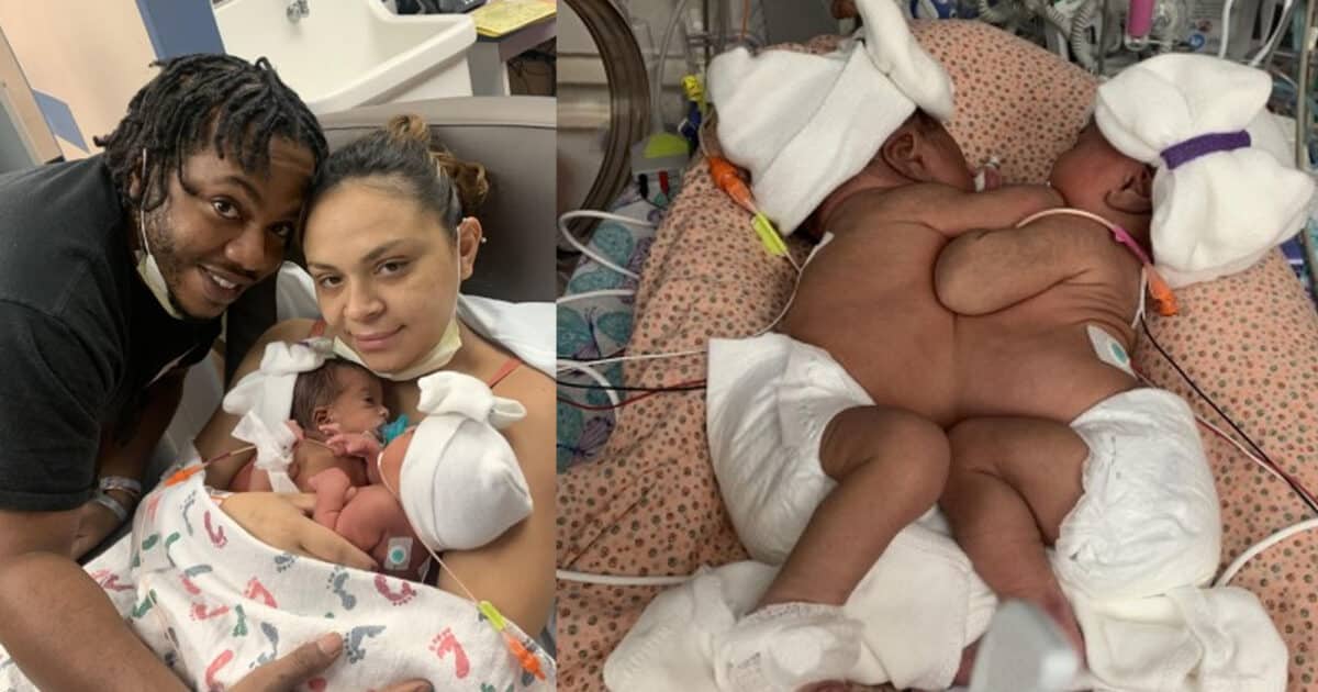 Amazing!  In historic surgery, conjoined twins are separated;  it took 11 hours