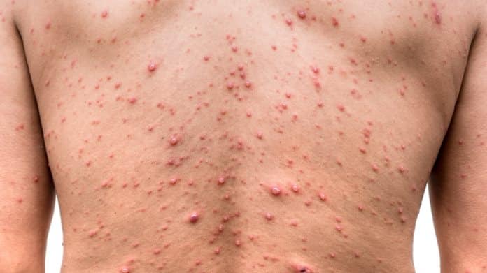 ¡En sólo dos semanas! Secretaría de Salud confirma al menos 49 casos de viruela del mono
