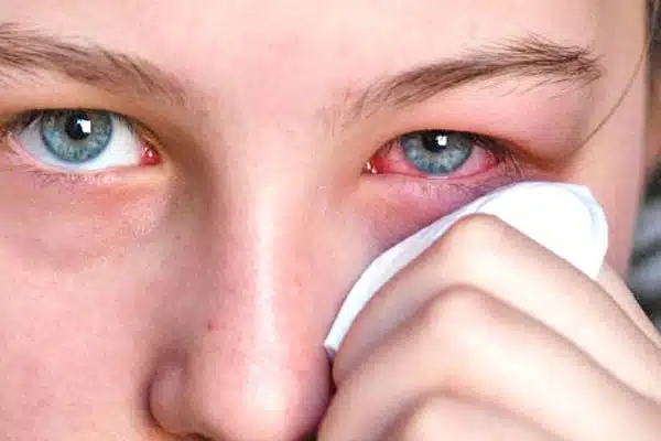 Conjuntivitis primaveral