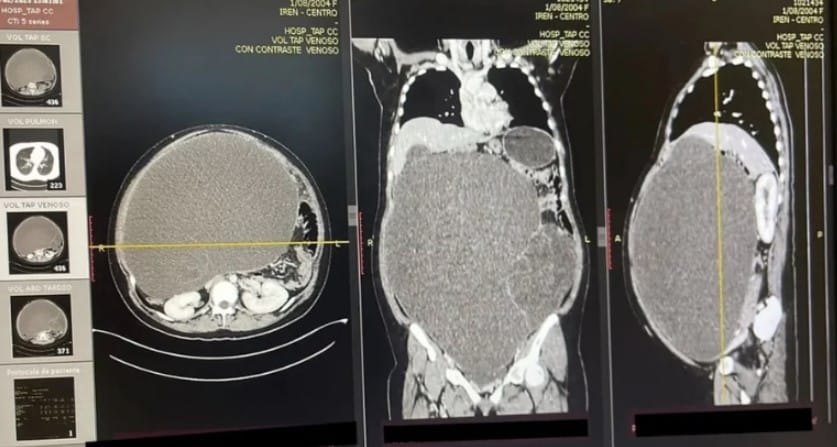 tumor abdominal 