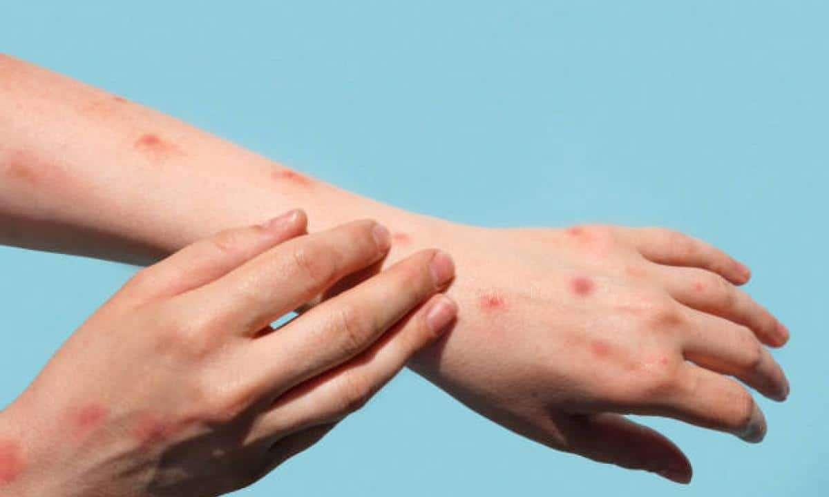 En los últimos meses, 90% menos casos de viruela del mono en el mundo