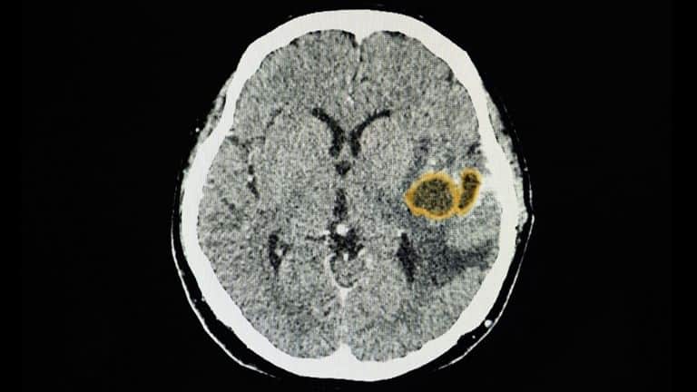 Médicos estadounidenses alertan por fuerte infección cerebral en menores de edad