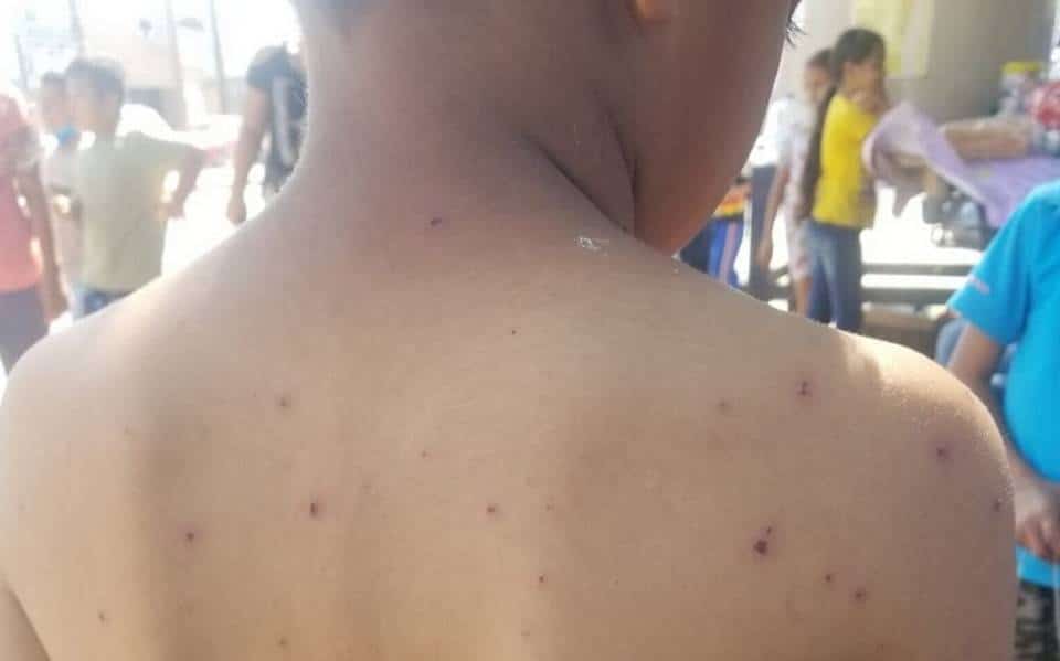 “Tenían varicela y los aislamos”: Detecta Salud Municipal pequeño brote de la enfermedad en Ahome