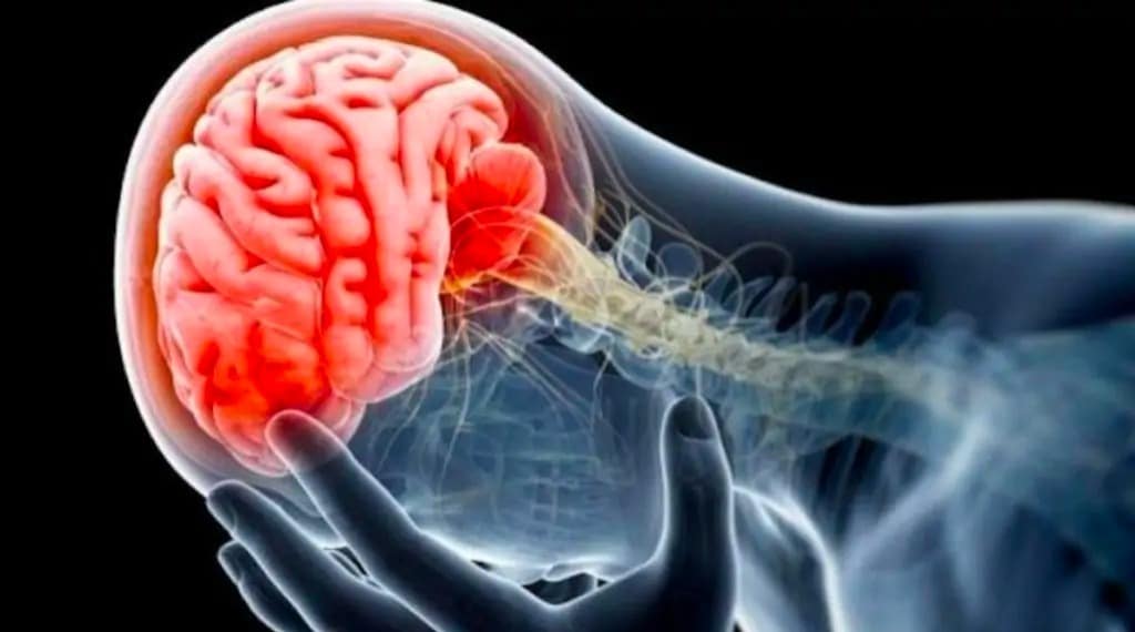 Meningitis Cerebro