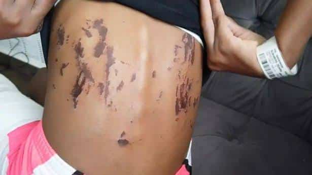 ¡Conmoción! Menor arrojó ácido a compañera de escuela; su mamá se lo dio