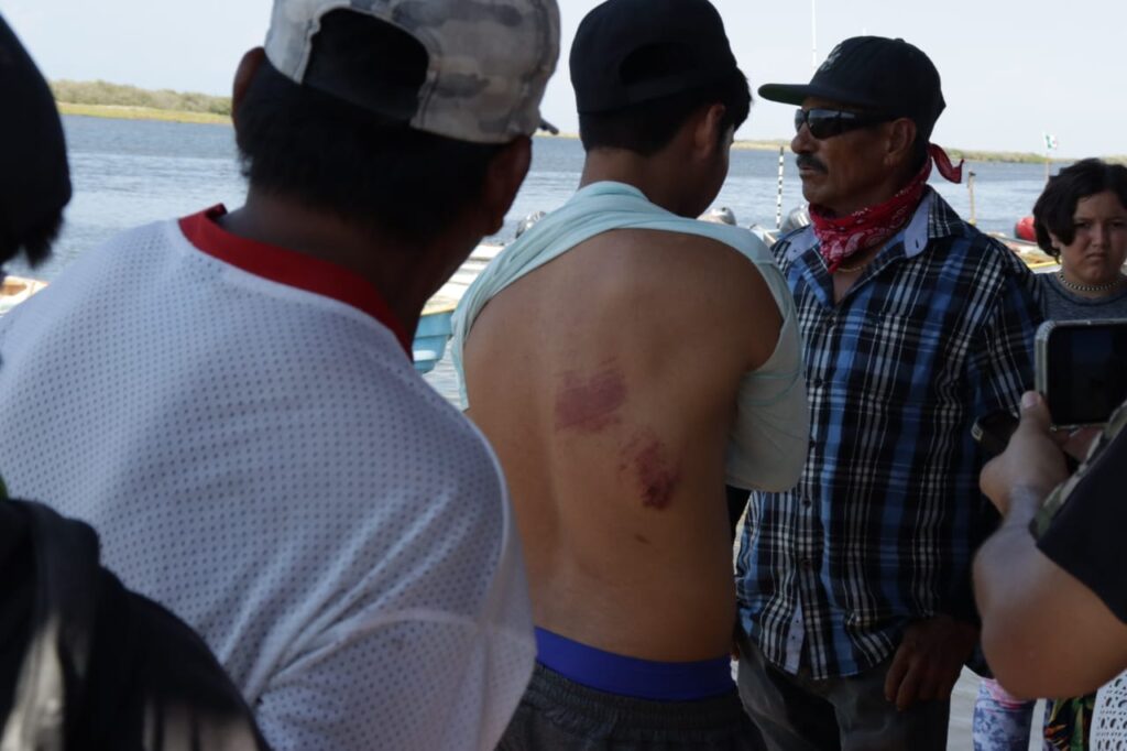 El joven Gabriel muestra las heridas en su espalda, resultado de lo ocurrido en el mar