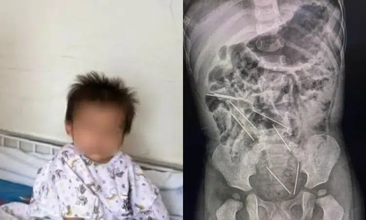 Niño de 2 años se traga 8 agujas y sobrevive