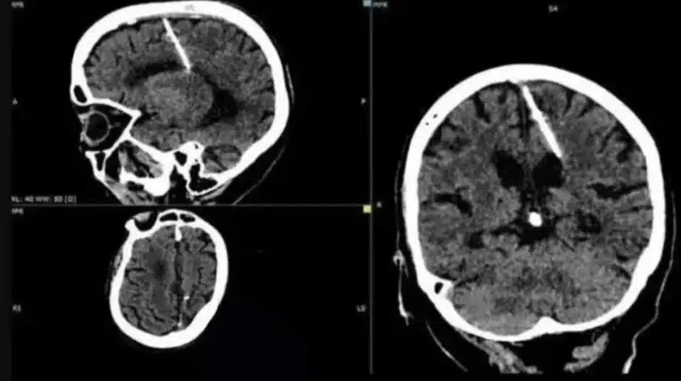 Mujer vivió 80 años con aguja en su cerebro