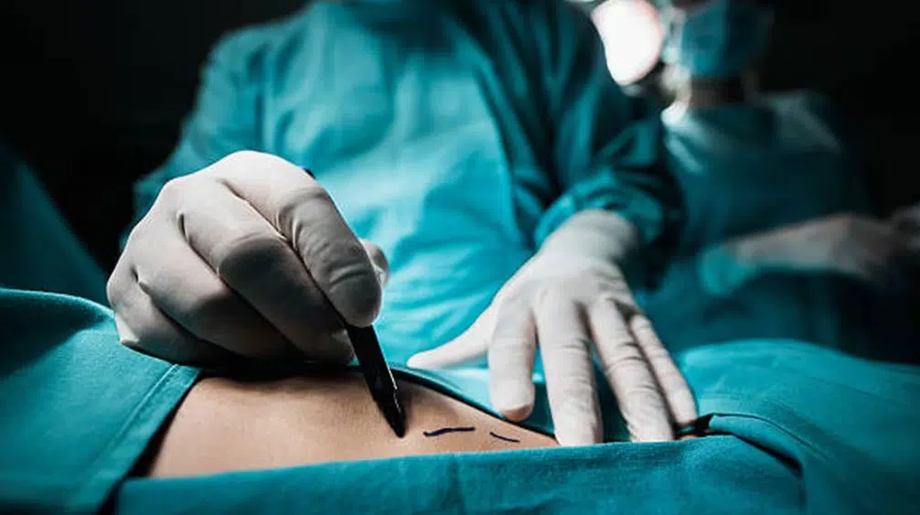 Enfermera muere tras someterse a liposucción en Colombia