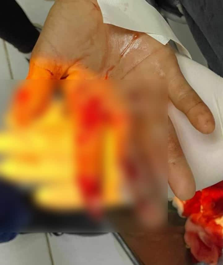 Lesion en mano