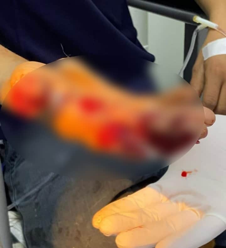 Lesion en mano