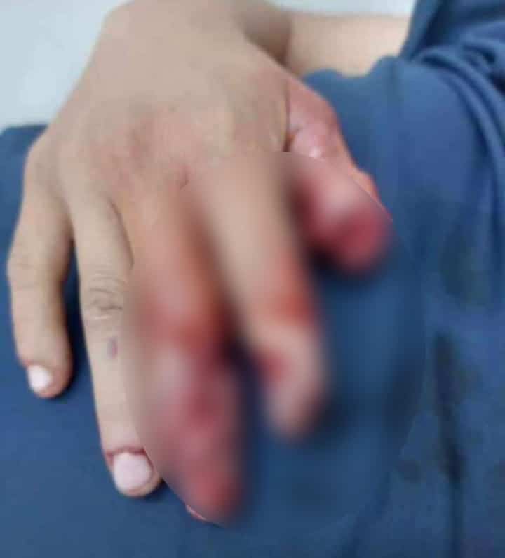 Lesion en mano