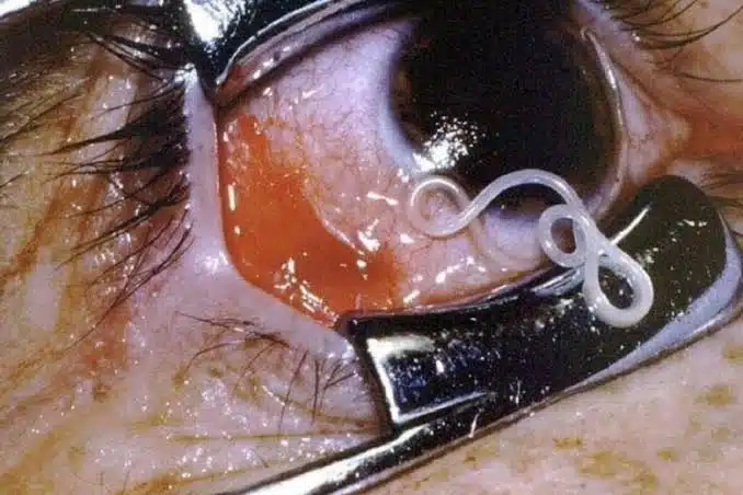 ¡Increíble! Extraen gusanos vivos de los ojos de una mujer en China