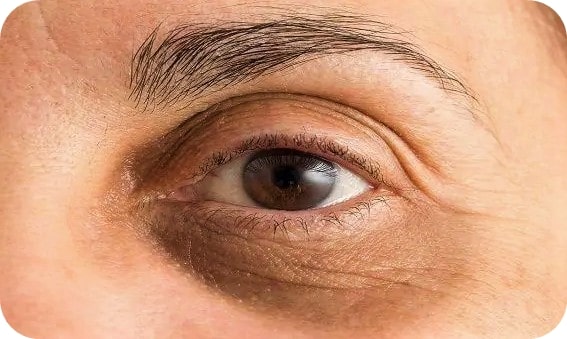 Ojeras en los ojos y bolsas