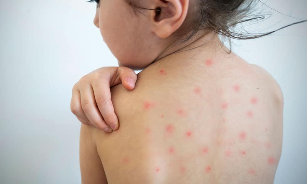 OMS alerta incremento en casos de sarampión en Europa