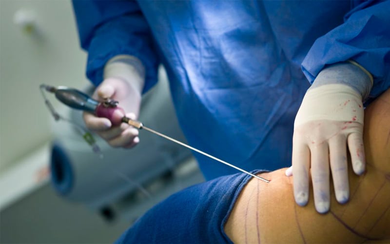 abdominoplastia