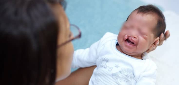 Bebe con hendidura orofacial