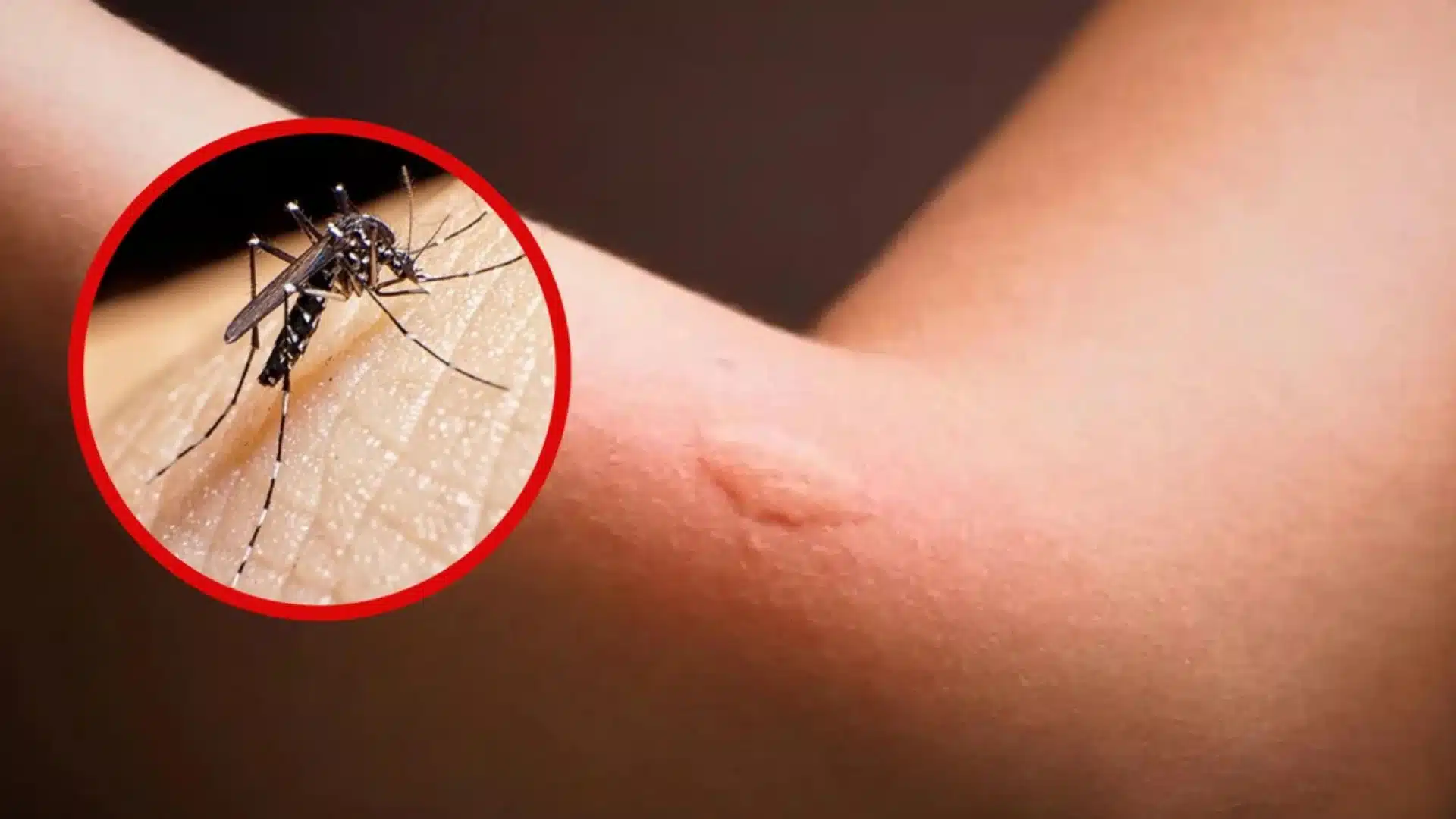 Picadura de mosquito dengue