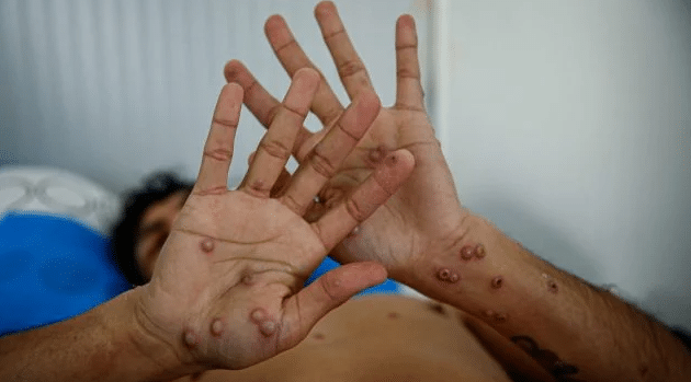 África ha registrado más de 18 mil 700 casos de mpox en lo que va del 2024