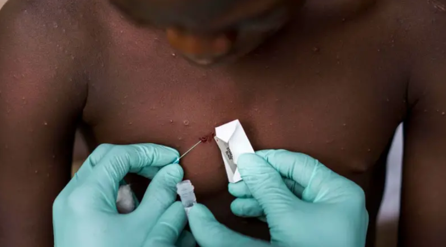 África: Incidencia de la viruela del mono se ha elevado un 160% en este 2024