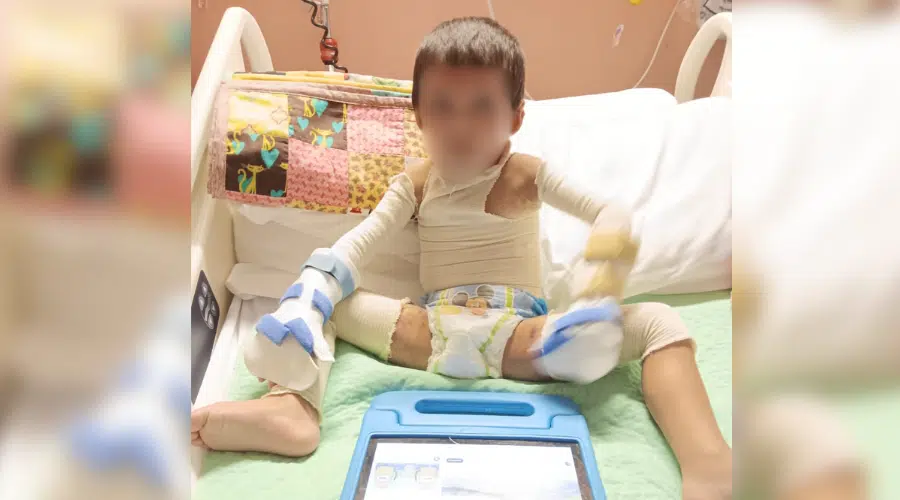 Ángel, el niño quemado en El Huitussi sorprende con increíble recuperación