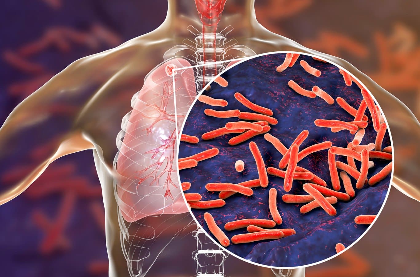 Alerta en Kansas, EU, por brote de tuberculosis que suma 2 fallecidos y casi 70 casos confirmados