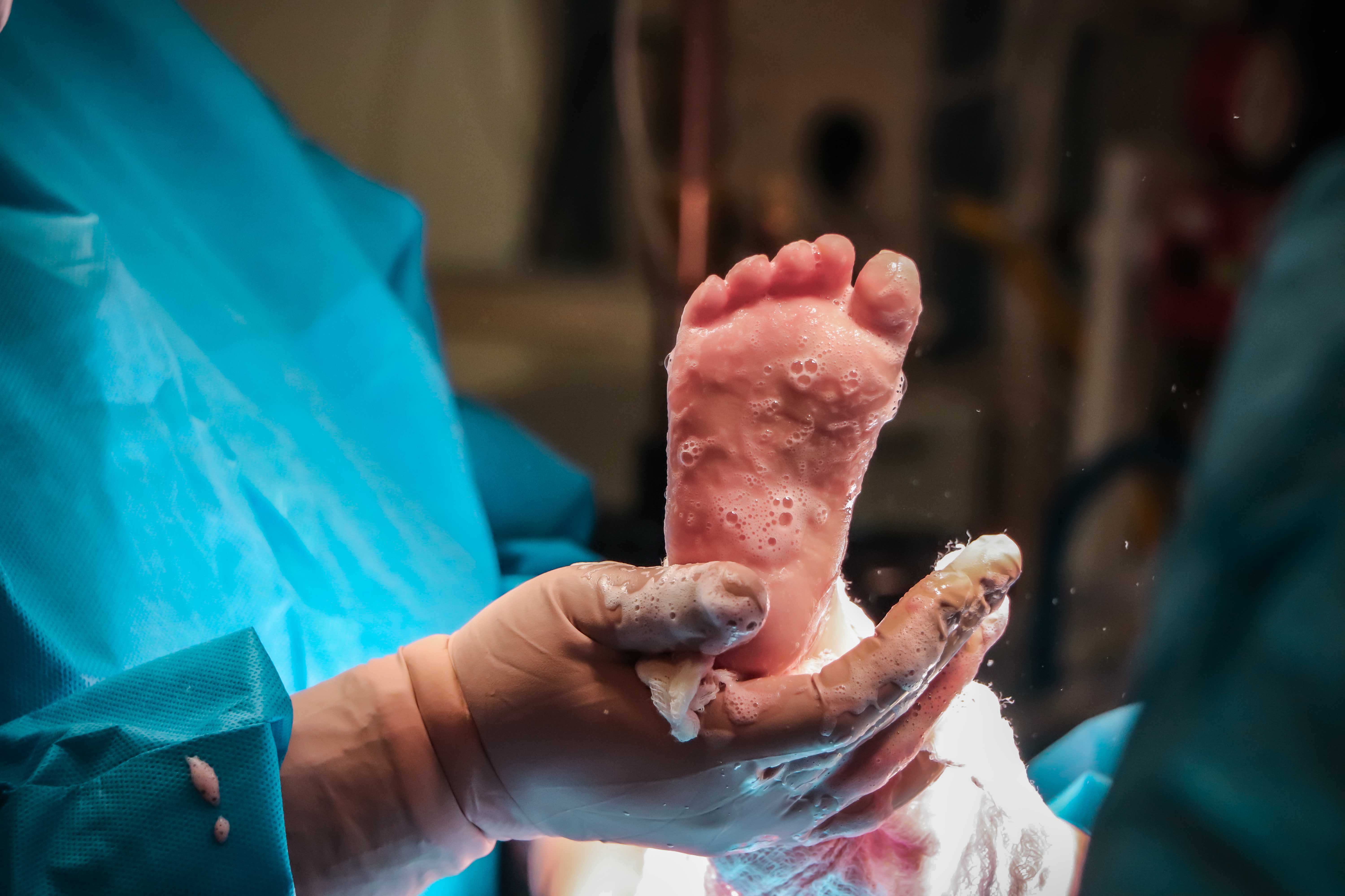 niño quemado en hospitl