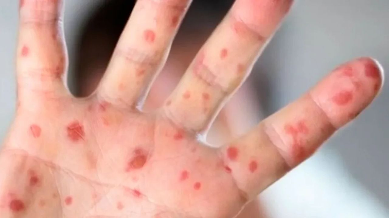 Detectan caso importado de sarampión en menor de Chiapas; activan cerco sanitario