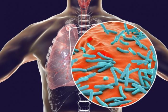 Salud confirma 76 casos de tuberculosis en Guasave, Juan José Ríos y Sinaloa municipio