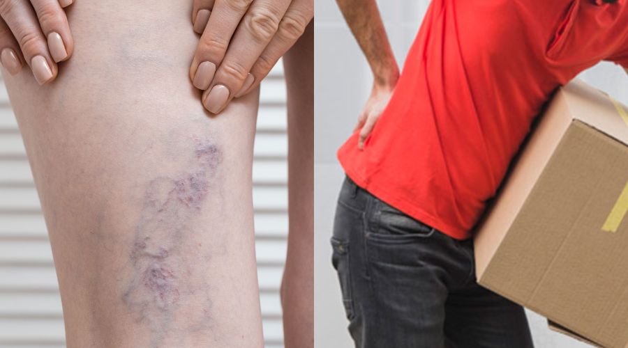 Pierna con varices y persona con dolor de espalda baja