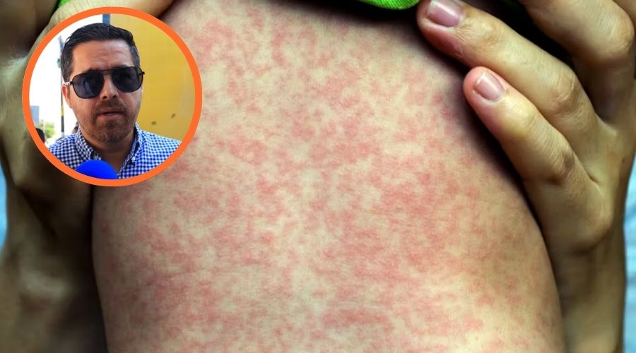 En Sinaloa se han podido contener casos de sarampión, pero llaman a los padres a vacunar a sus hijos