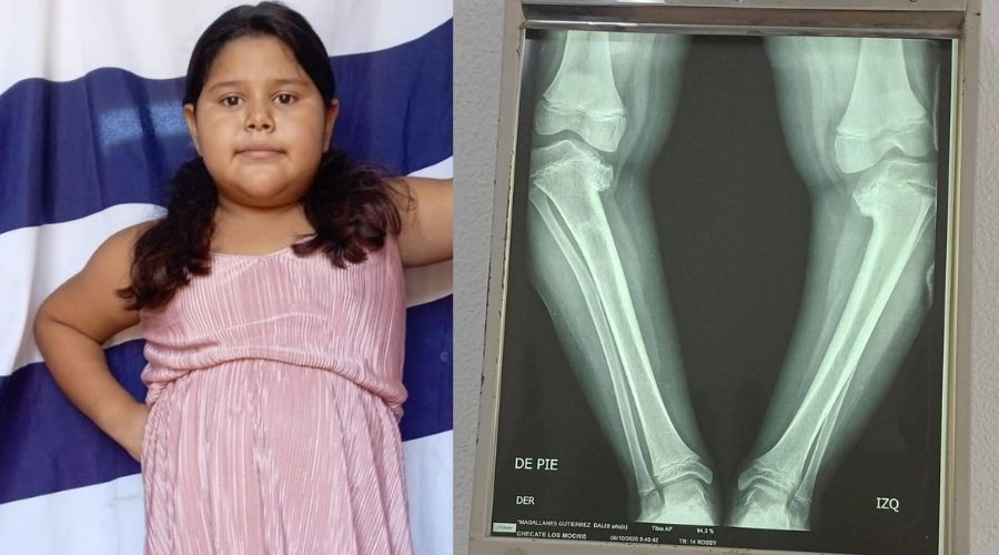 Abigaíl necesita solventar cirugía por una condición en sus piernas