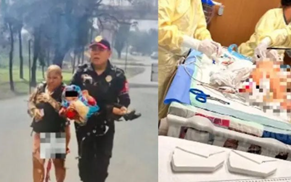 Recibe injertos en manos, piernas y cabeza la nieta de la 