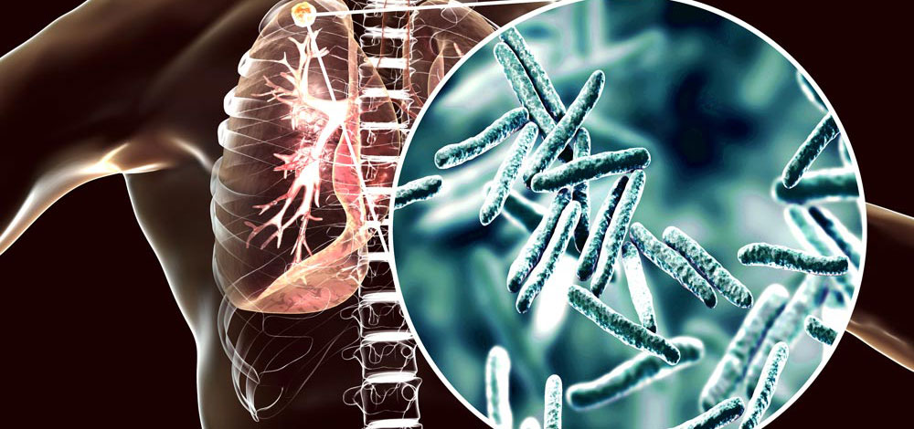 Más de 1.2 millones murieron por tuberculosis en 2024; reporta OMS su primer descenso global