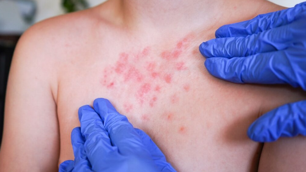 Sarampión es el virus más contagioso, alerta la UNAM