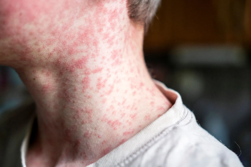 Estados Unidos enfrenta uno de los mayores brotes en décadas con más de mil casos de sarampión