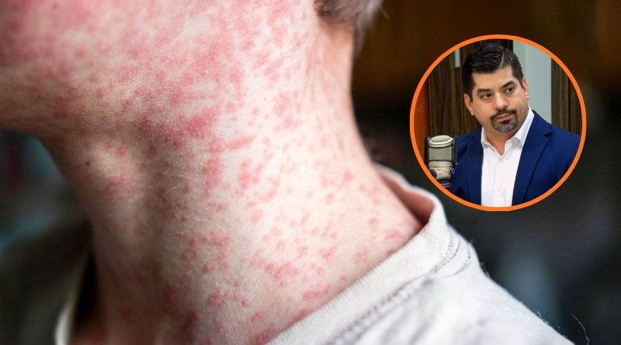 Persona con sarampión y en un círculo Gerardo Kenny Inzunza Leyva,