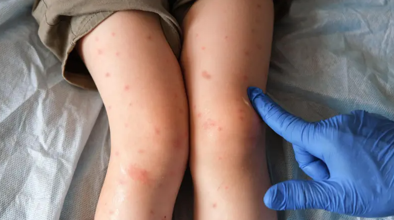 Reportan más de 12 mil contagios y 34 muertes por sarampión en México
