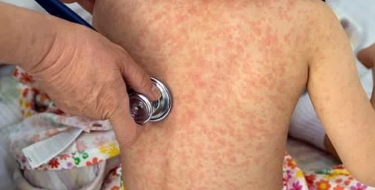 México enfrenta un brote de sarampión con casi 14 mil contagios