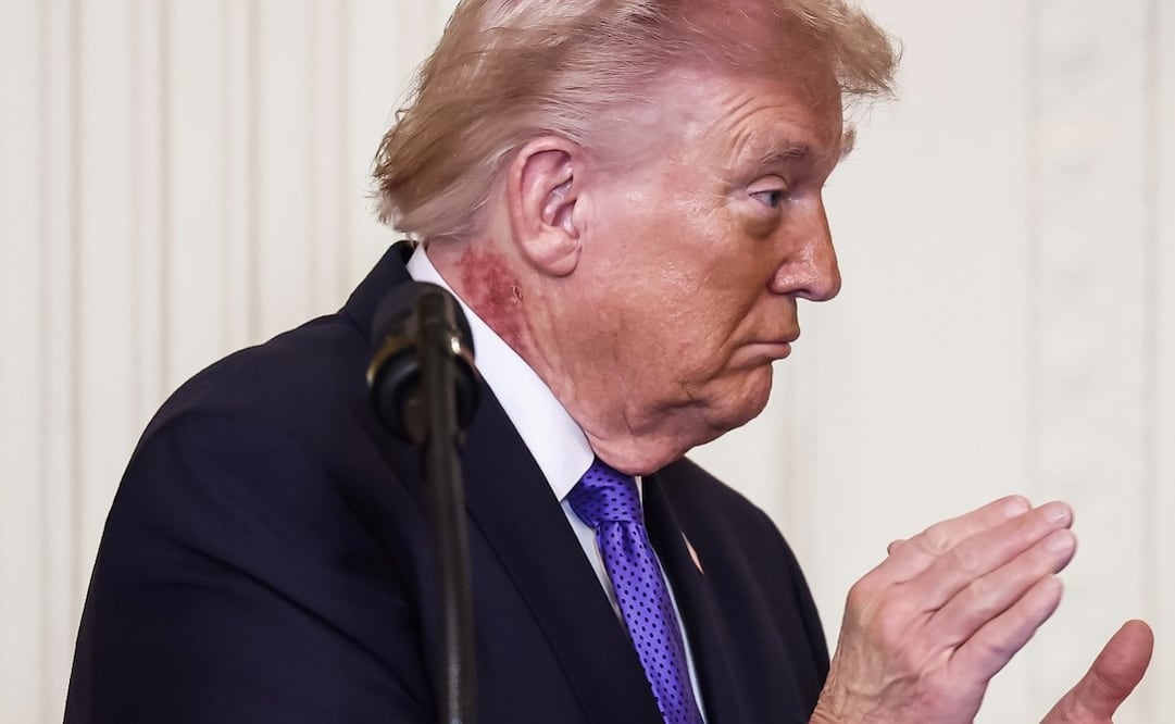 Erupción cutánea en el cuello de Trump desata especulaciones sobre su salud; médico responde