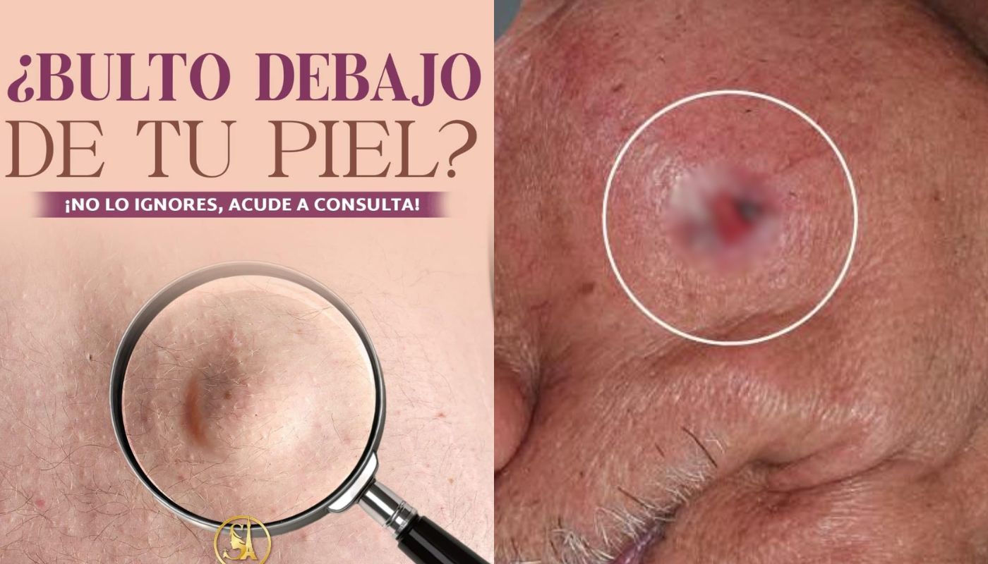 Piel con una roncha color rojo con un anuncio cáncer de piel
