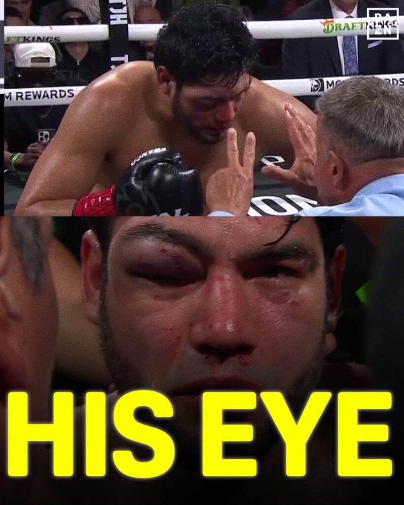 Zurdo Ramírez con ojo hinchado