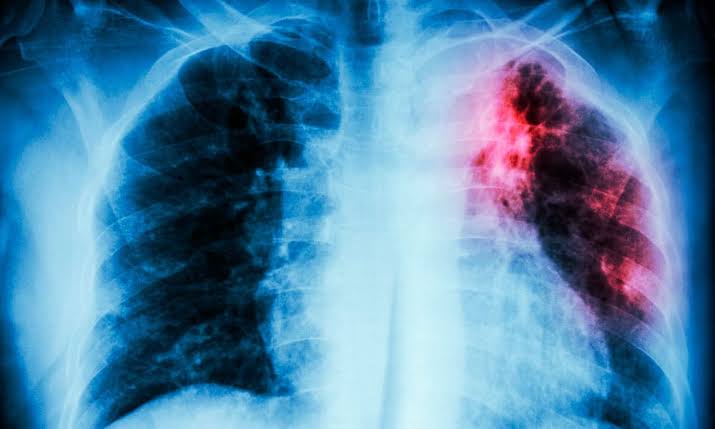 rayos x de pulmones